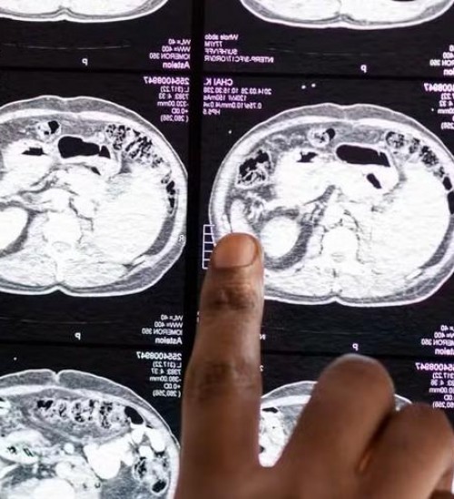 Adolescente de 13 anos morre após complicações de meningite em Sinop