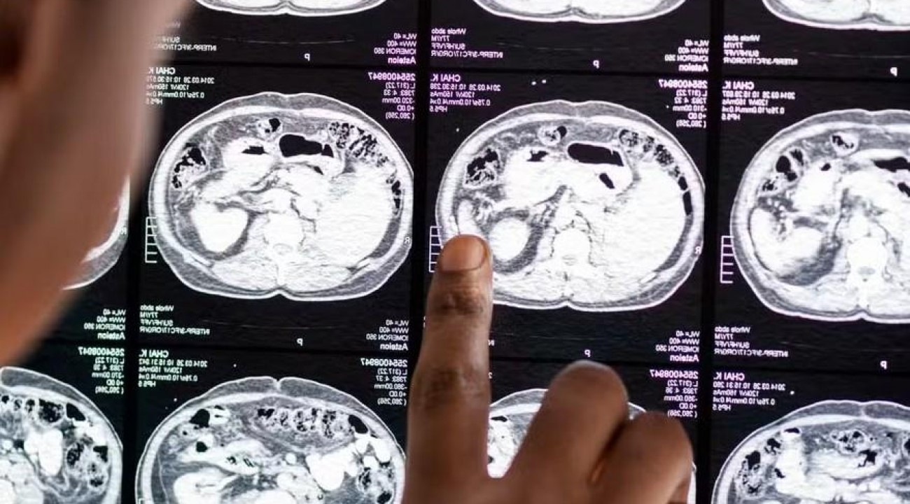 Adolescente de 13 anos morre após complicações de meningite em Sinop